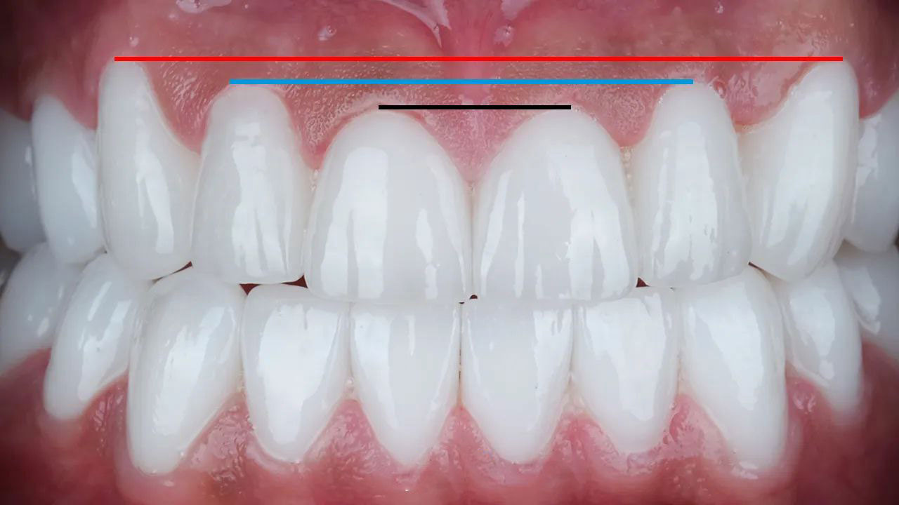 تفاوت لمینت و کامپوزیت چیست؟ | دندانپزشکی دکتر مرادزاده